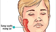 Biểu hiện lâm sàng phổ biến nhất của bệnh là viêm tuyến nước bọt mang tai không hóa mủ. 