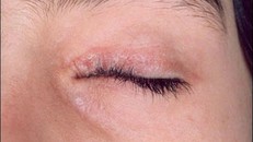 Vảy nến mí mắt có thể gây co kéo mí cụp vào trong khiến lông mi cọ vào nhãn cầu.