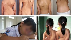 Cảnh báo nguy cơ cong, vẹo cột sống ở học sinh