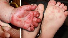 Nếu không được phát hiện và điều trị kịp thời, bệnh có thể gây nhiều biến chứng nguy hiểm.