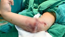 Bệnh nhân 8 tuổi đã được nối lại cẳng tay bằng vi phẫu thuật. Ảnh: BVCC. 