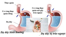 Trào ngược dạ dày - thực quản. (Ảnh: Sức khoẻ & Đời sống)