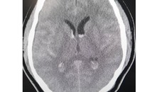 Hình ảnh phim chụp xuất huyết dưới nhện lan tỏa - tụ máu não thất. (Ảnh: Nhân Dân)