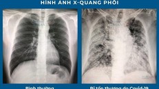 Hình ảnh X-quang phổi bị tổn thương do COVID-19. (Ảnh: Kiểm Sát Online)