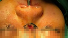 Đi nâng mũi, thiếu nữ bị sụn silicon đâm lòi sống mũi