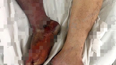 Hoại tử chân do uống thuốc tim mạch không đều