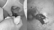 Bệnh nhân 32 tuổi nhập viện trong trình trạng có lỗ rò chảy máu, dịch mủ liên tục từ ngực tiêm filler.