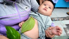 Bé gái bị bỏng nặng vùng ngực do người nhà trị sổ mũi cho bé bằng lá trầu không.