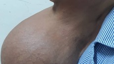 Bệnh nhân với cục bướu khổng lồ đeo bám suốt 20 năm ảnh hưởng lớn đến sinh hoạt.