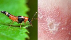 Chất độc kiến ba khoang khi tiếp xúc với da người có thể gây tổn thương da.