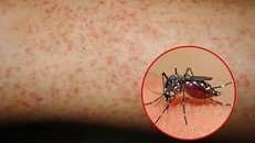 Bệnh SXH gây ra nhiều biến chứng nguy hiểm.