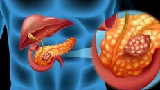 Ung thư tụy nguy hiểm như thế nào?