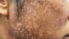 Sau một thời gian sử dụng kem trộn, da mặt bệnh nhân bị sạm đen lỗ chỗ.