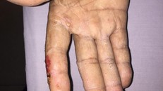 Nhiễm độc asen lâu ngày dễ biến chứng thành ung thư da