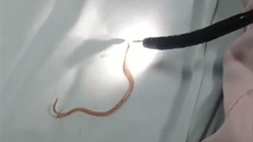 Bác sĩ tiến hành gắp giun ra khỏi ống tụy bệnh nhi. Ảnh BVCC