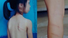 Nhiều vết bầm tím xuất hiện trên chân và phía sau lưng cháu Hoa. Ảnh: N.A