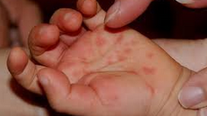 Bệnh tay chân miệng vào mùa, nhiều ca nặng