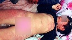 Con anh Nhất bị đánh bầm tím toàn thân