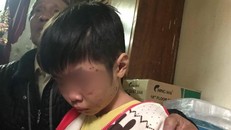 Mới đây, bé K 10 tuổi bị bố đánh đến rạn sọ não 