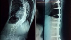 Cột sống bệnh nhi cong vẹo trước mổ (bên trái) và được nắn chỉnh sau mổ