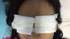 Con dâu bị mẹ chồng tạt axit bỏng hai mắt