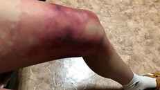 Đôi chân bầm tím và sưng phù của cô gái