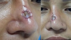 Cô gái Sài Gòn 'bực bội' chia sẻ hình ảnh mũi sưng đen sau tiêm chất làm đầy