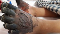 2 bàn chân tím đen vì hoại tử cũng sẽ phải phẫu thuật cắt bỏ