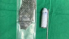 Cô gái đầu tiên trên thế giới được tái tạo âm đạo bằng da cá rô phi