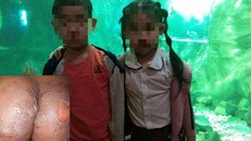 Hai cháu bé bị bỏng do bị hắt nước sôi vào người.