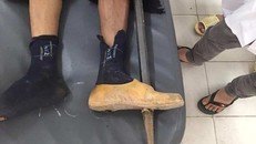 Chiếc xà beng đâm xuyên thấu bàn chân nam thanh niên