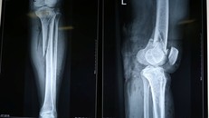 Cứu người đàn ông gãy chân, đứt mạch máu khi sang đường