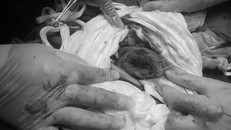 Các bác sĩ BV Sản Nhi Nghệ An thực hiện ca phẫu thuật