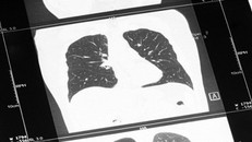 9 căn bệnh gây tử vong nhiều nhất trên thế giới