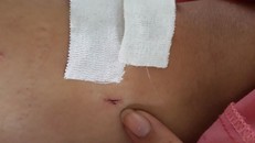 Anh Th bị khoan nhầm vào chân trong khi anh bị chấn thương gãy đốt sống ngực