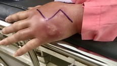 Bàn tay người phụ nữ sưng nề sau khi tiêm omega làm đầy. Ảnh: BH.