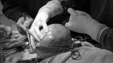 Khối u quá lớn, chèn ép nội tạng và dính vào nhiều cơ quan lân cận 