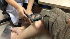 Hàng nghìn người viêm da nặng do tiếp xúc với kiến ba khoang 