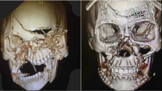 Ảnh chụp vùng mặt nữ bệnh nhân trước và sau phẫu thuật. Ảnh: Figure 1.