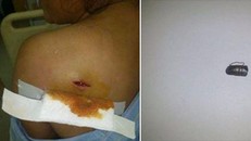 Đầu đạn (bên phải) được phẫu thuật gắp ra từ người bà Nguyễn Thị Tý.