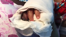 Ngón tay út của bé P. đã bị hoại tử. Ảnh: Bác sĩ cung cấp.