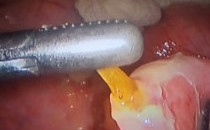 Ăn canh chua cá tai tượng bị xương đâm thủng ruột