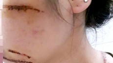 Chị Hạnh bị nhóm côn đồ chém trọng thương