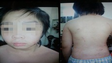 Toàn bộ thương tích trên người bé trai. Ảnh: Vietnamnet