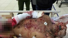 Nạn nhân hiện đã được chuyển lên Hà Nội điều trị. Ảnh: Báo Nghệ An