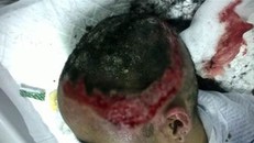 Thiếu nữ bị bỏng nặng vùng da đầu do máy uốn tóc