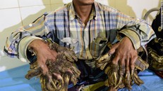 Người cây Bangladesh tiếp tục trải qua phẫu thuật