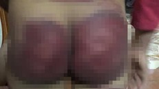 Các vết thâm tím trên người bé gái do bị bố vụt bằng thanh tre. Ảnh: VTC News