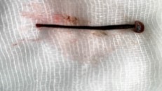 Con đĩa dài 4cm trong hốc mũi bệnh nhân Th. được gắp ra ngoài thành công. Ảnh: NLĐ