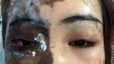 Một bên mặt của chị V. bị bỏng nặng. Ảnh: VietNamNet